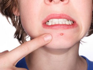 Logra evitar el acné adulto 