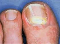 Cuidado de las uñas de los pies 