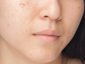 Conocer y prevenir las manchas en la piel 