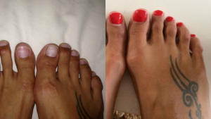 acortarse los dedos de los pies antes y después 