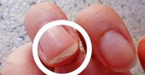 Por qué se descaman las uñas y cómo solucionarlo